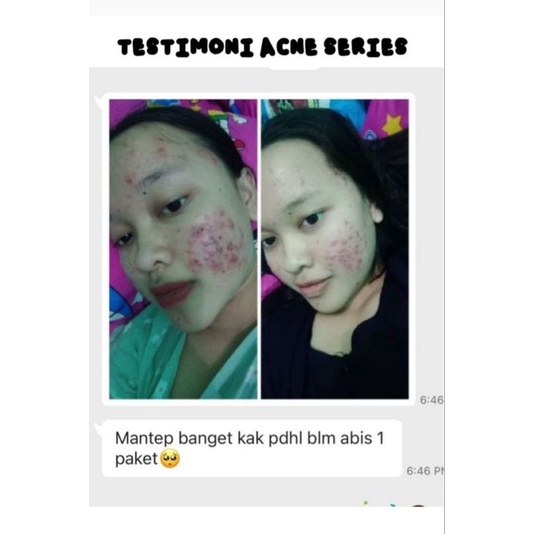 Daviena skincare medan - Acne series Komplit / Paket Hemat Acne 1-2 Best seller-4