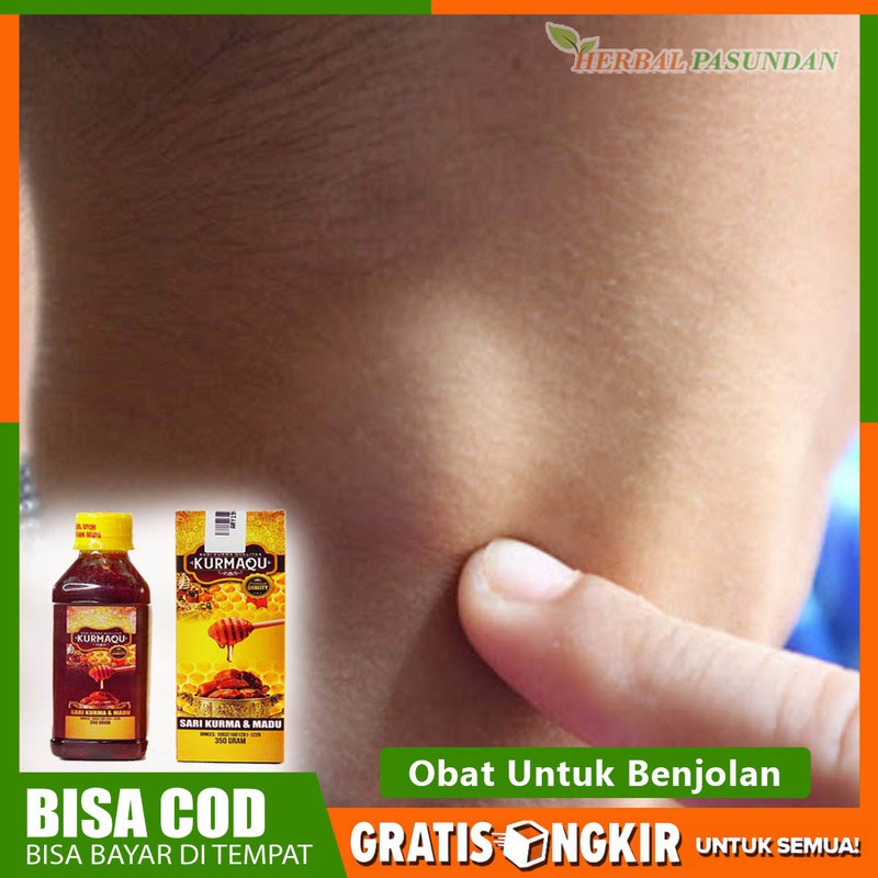 Obat Benjolan Lipoma, Kelenjar Getah Bening Leher Gondok Sari Kurma Dan Madu Kurmaqu Di Tasikmalaya