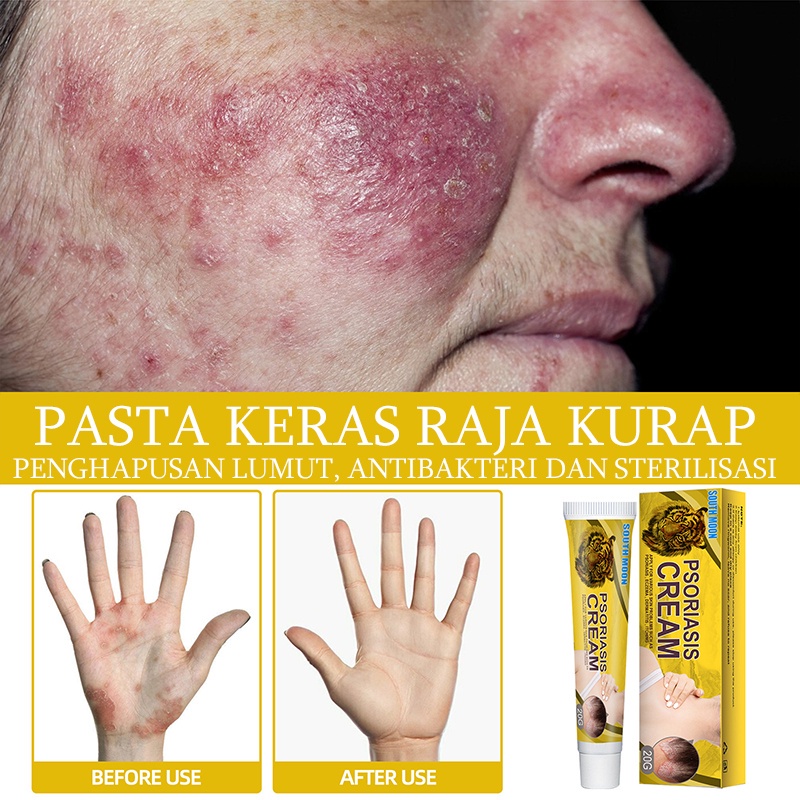 Salep Gatal Obat Gatal Kulit 20g Kulit Kepala Psoriasis Tangan Tinea Kaki Bau Versicolor Menghambat Dermatitis Jamur Salep Gatal Paling Ampuh