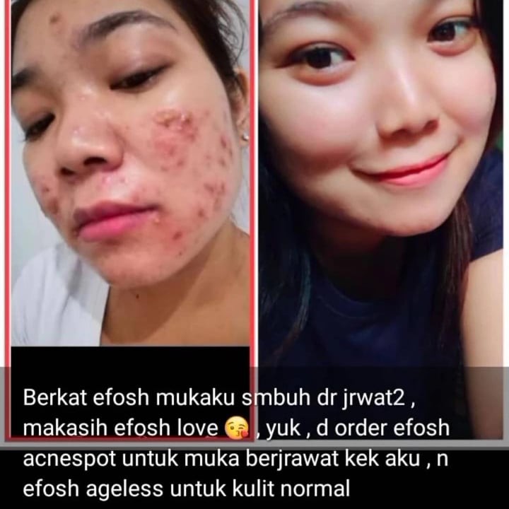 Efosh Skincare Acnespot BPOM