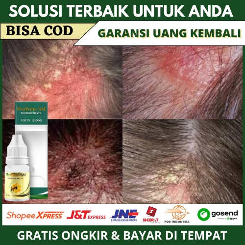Obat Borok Kepala, Ketombe Berkerak, Dermatitis Seboroik, Kulit Kering Mengelupas Di Kepala, Obat Lu
