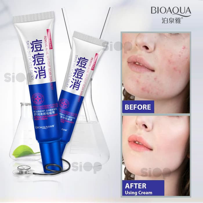 Beauty Cream BIOAQUA Anti Acne- Oil Control- Acne Scar Remove