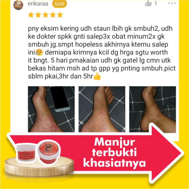 Salep Saleb Gatal Paling Ampuh Obat Luka Diabetes Gatel Selangkangan Eksim Kering Basah Menahun Panu Kutu Air-2