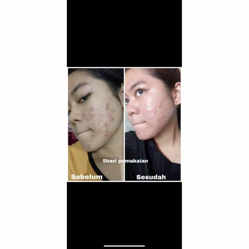 Facial Wash Acne Scrub Cleansing Clear Jerawat Sabun Wajah Bpom Farma Dokter Korea BYOUT SKINCARE-4