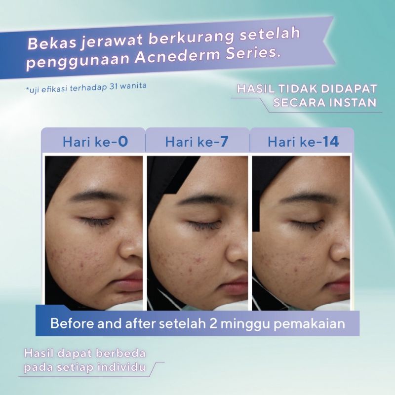 Wardah Acnederm Acne Care Serum 15ml - Serum Jerawat