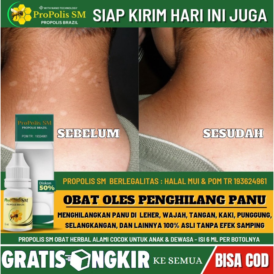 Salep Panu, Penghilang Panu di Wajah / Leher / Punggung / Perut Secara Alami, Obat Panu Oles, Obat K