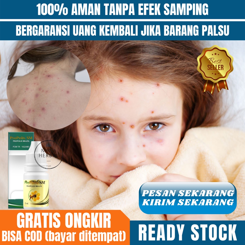 Obat Cacar Air, Ruam Kemerahan Cacar Air, Gatal Cacar Air, Cacar Air di tangan, di wajah, di kaki, d