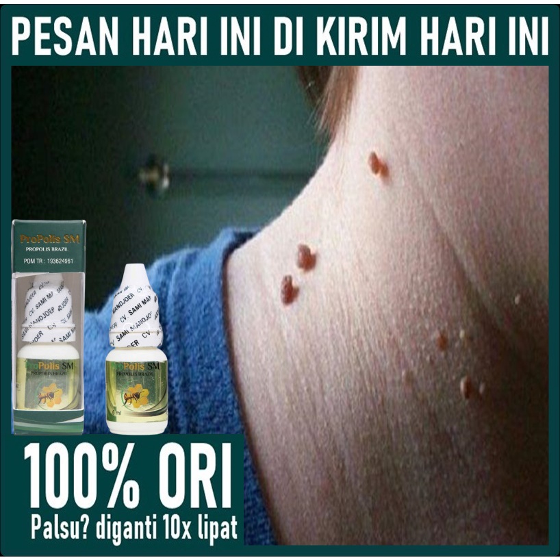 Obat Penghilang Papiloma di Leher, Perontok kutil di Leher, Obat Oles Kutil di Leher, Obat Papiloma