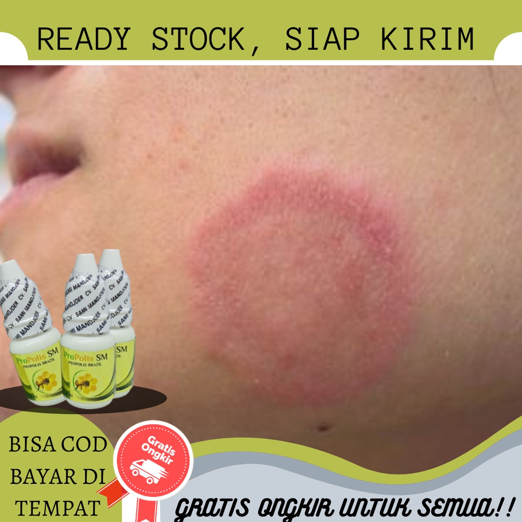 Obat Panu Cair, Obat Panu Anak, Obat Balas Bogo, Obat Panu Wajah, Obat untuk Panu, Obat Panu Alami, 