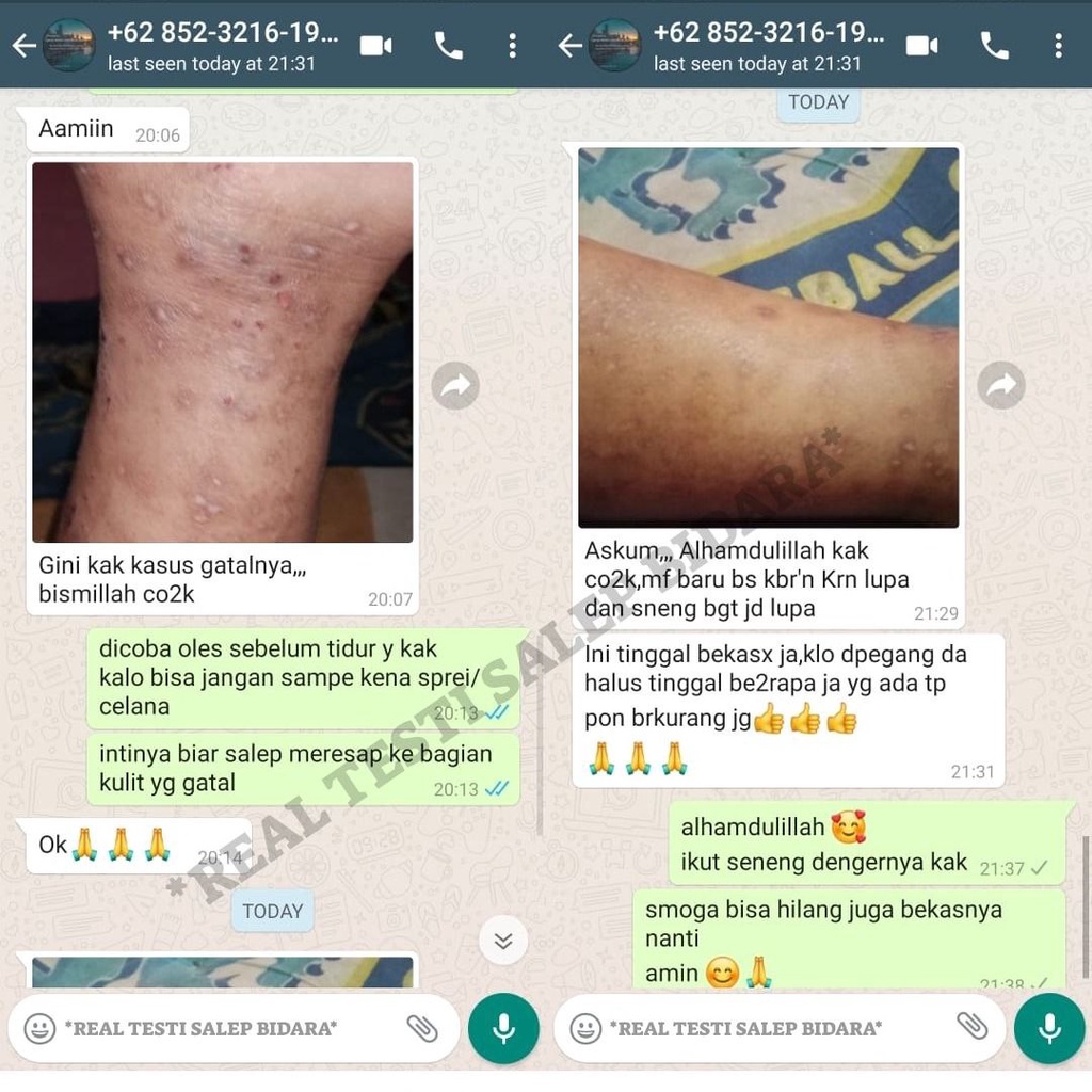 Obat Kurap Paling Ampuh Gatal Panu Jerawat Jamur Kulit Kutu Air Selangkangan Eksim Kering Luka Basah salep Bidara Sirih saleb gatal