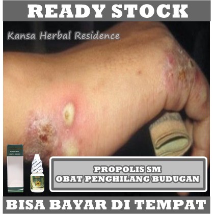 Obat Penghilang Bekas Budug Di Kaki Tangan Badan, Obat Gudik, Obat Kudis, Gatal Gatel, Kulit Borok, Obat Scabies Paling Terbukti, Obat Herbal Gudig Gudik, Obat Untuk Gatal Dengan Propolis SM Brazil