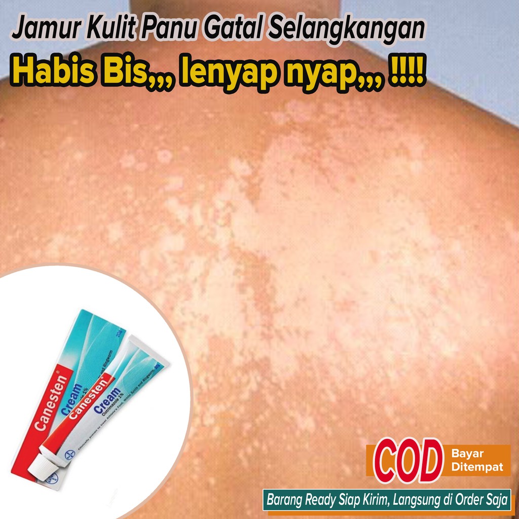 Salep Obat Panu Gatal Selangkangan gatal jamur Kurap Kutu Air BANDEL Ampuh ~ Canesten Cream 5gr