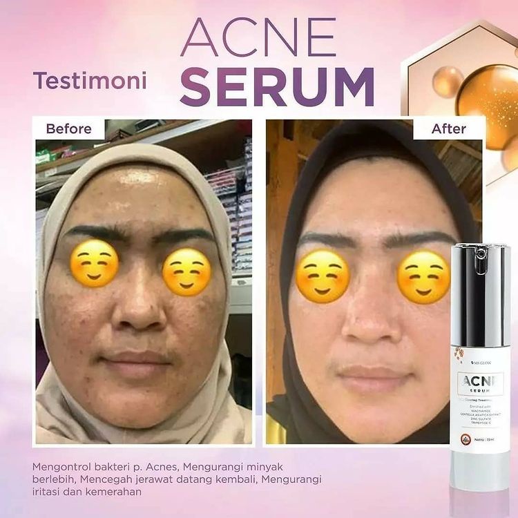 Ms Glow Acne Serum Ms Glow Original 100% Serum Acne Jerawat Beruntus Ms Glow