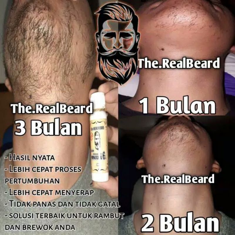 Minoxidil ori