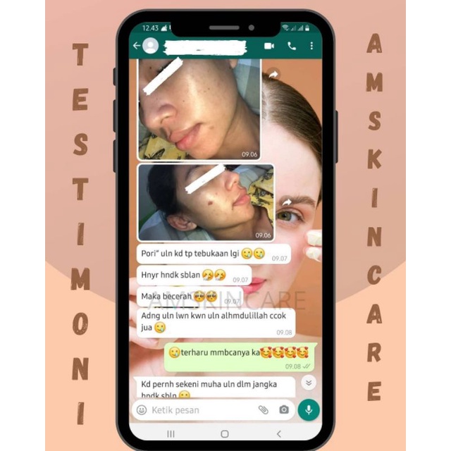 CREAM MALAM ACNE/JERAWAT BY AMSKINCARE | AMPUH USIR JERAWAT BANDEL BERUNTUSAN BOPENG