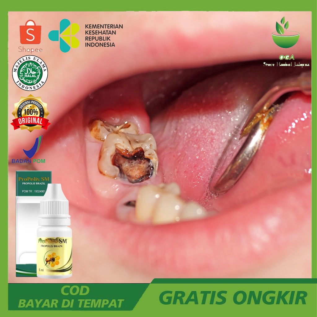 Obat Tetes Polip Gigi, Obat Kumur Polip Gigi, Benjolan Pada Gigi Berlubang, Obat Polip Pulpa Gigi