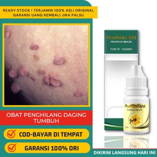 Jual Obat Daging Tumbuh Alami - Menghilangkan Daging Tumbuh di Dalam