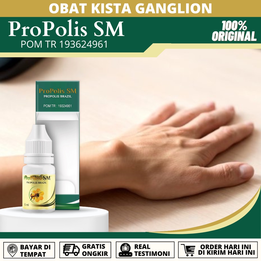Obat Kista Ganglion di Tangan, Ganglion Benjolan di Tangan, Kista Ganglion di Pergelangan Tangan, Pe
