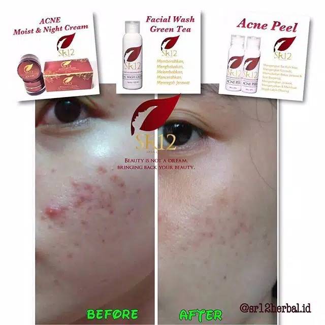 ACNE MOIST SR12 / ATASI JERAWAT