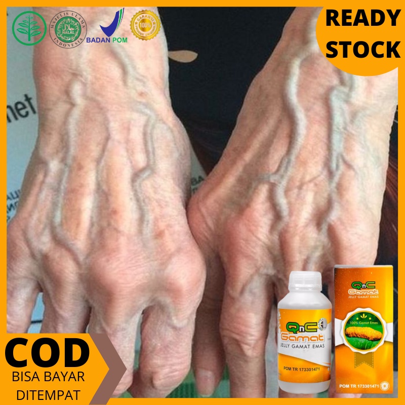 Obat penghilang Varises di tangan dan kaki, Obat varises di betis, Obat Penghilang Varises, Obat Ura