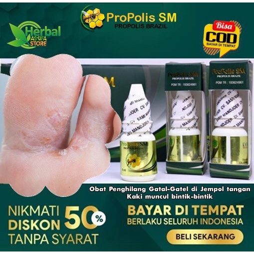 Obat Penghilang Gatal-Gatel di Jempol tangan/Kaki muncul bintik-bintik, terasa gatal, pecah, kering 