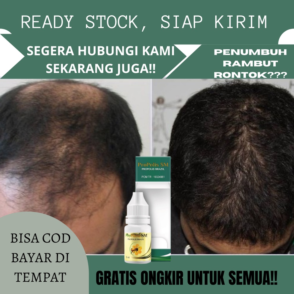 Obat Rambut Rontok, Anti Ketombe, Obat Rambut Rontok Anak, Obat Rambut Rontok Wanita, Obat Rambut Ro
