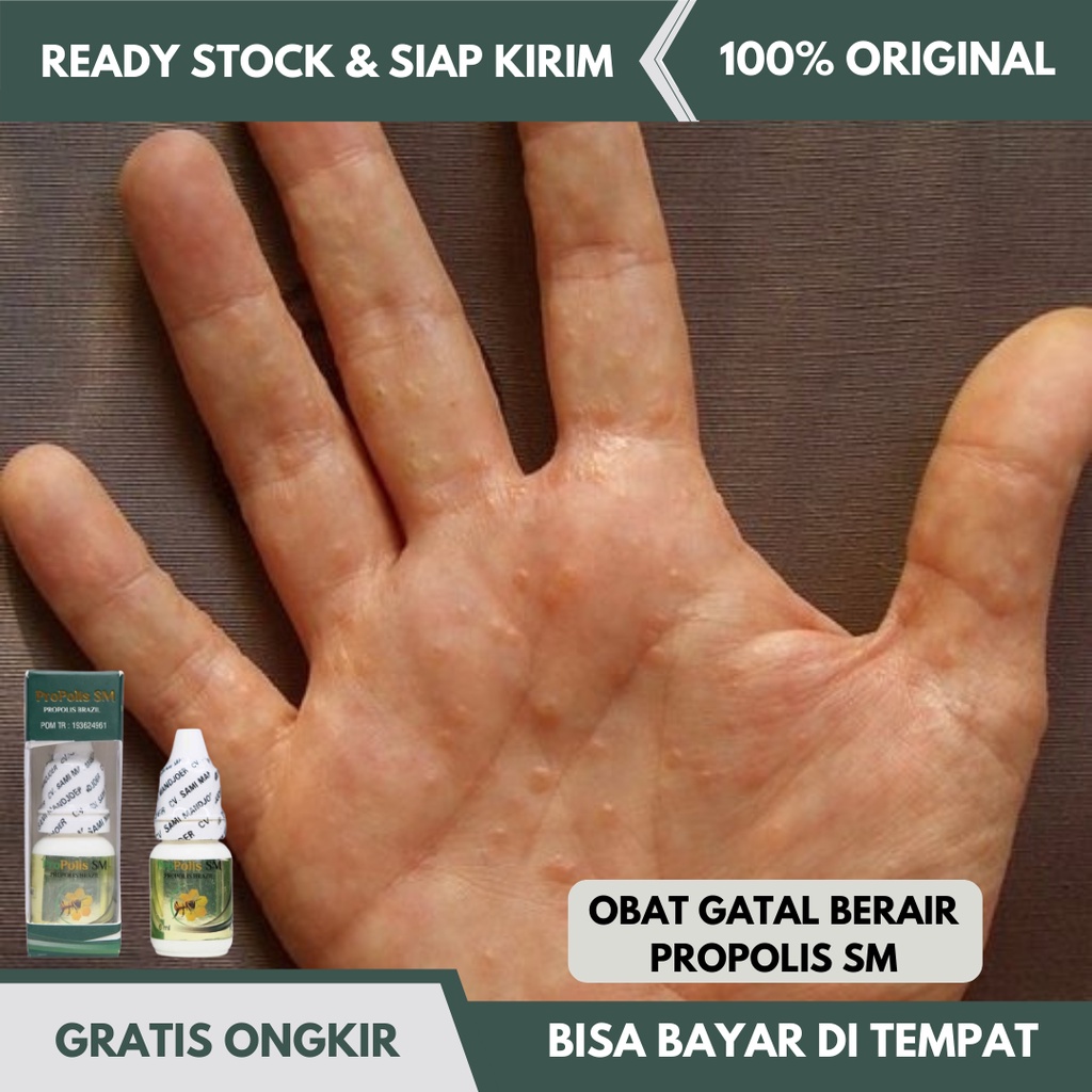 Jual Obat Gatal Berair Di Jari Tangan Dan Kaki Obat Gatal Bintik Berair Di Tangan Obat Bintik 1494