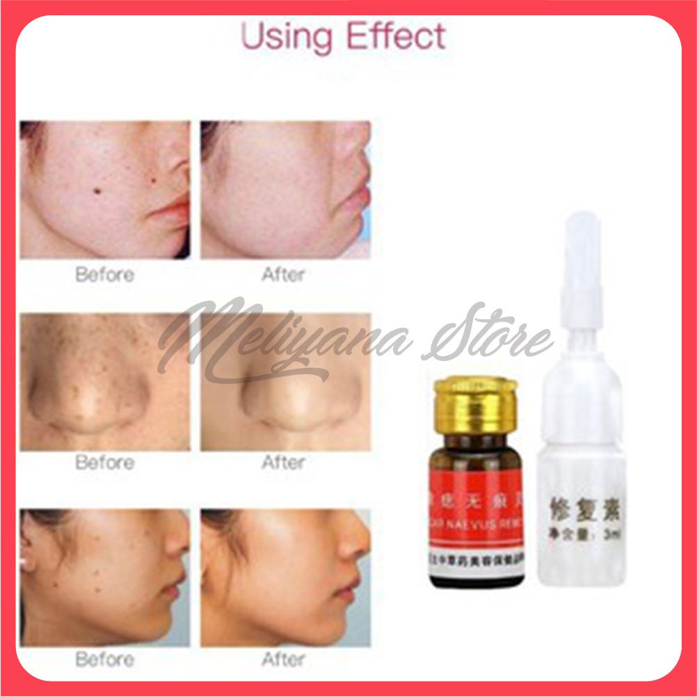 Penghilang Kutil Tahi Lalat Spot Skintag Remover