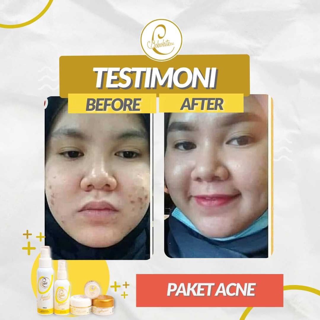 BEBWHITE C BBC BBWHITE GLOW ACNE DAYCREAM TOTOL JERAWAT PERAWATAN WAJAH BERMINYAK