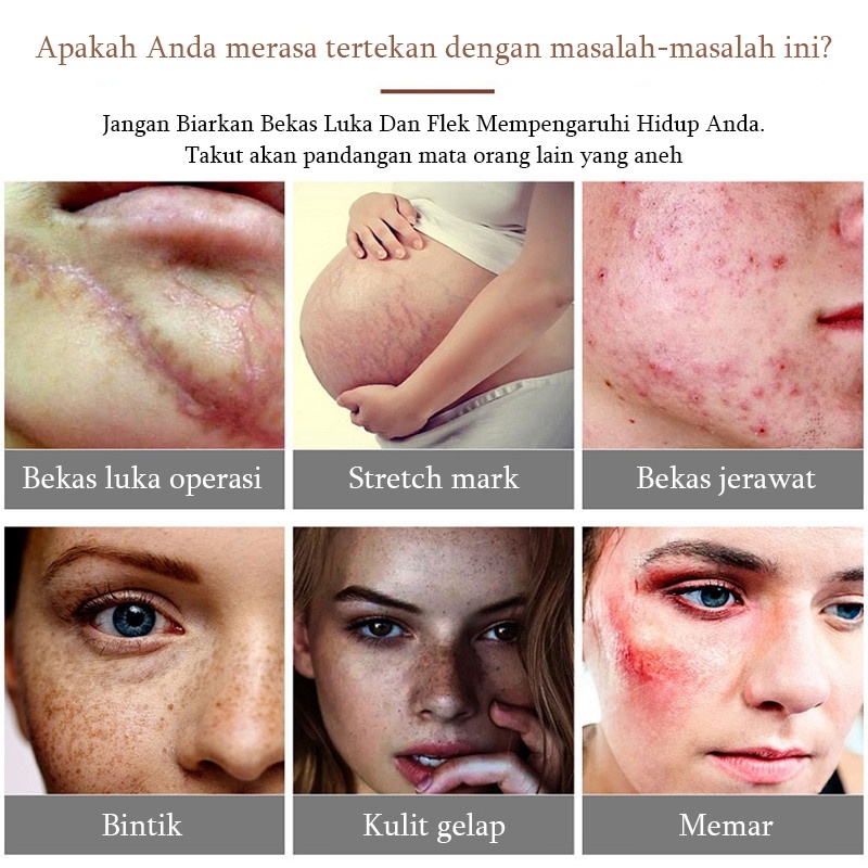 Krim Cream Salep penghilang luka bekas Menghilangkan stretch mark Penghilang bekas luka yang ampuh Memperbaiki bekas luka bakar Bekas Jerawat Bekas luka lama Benjolan dan jerawat 50G