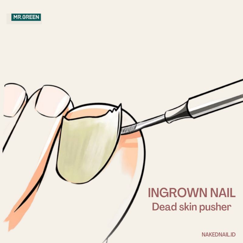 pusher kaki ingrown nail cuticle pusher dead skin pedicure toenail  MR GREEN