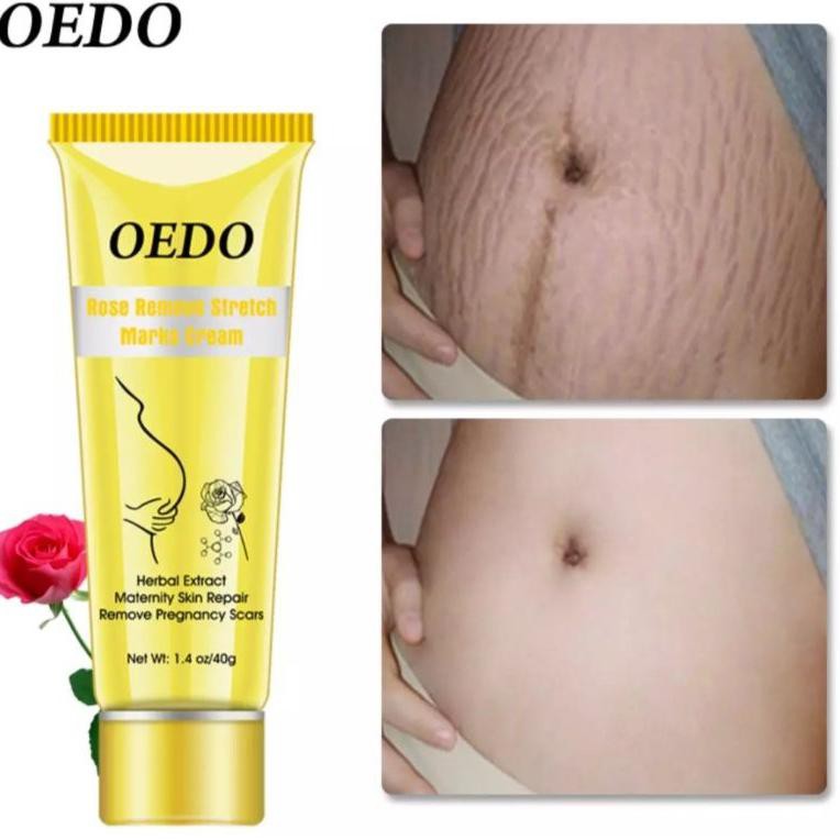 Kode V5010 Oedo Mawar Menghapus Stretch Marks Krim Bersalin Menghilangkan Bekas Luka Kehamilan Shopee Indonesia