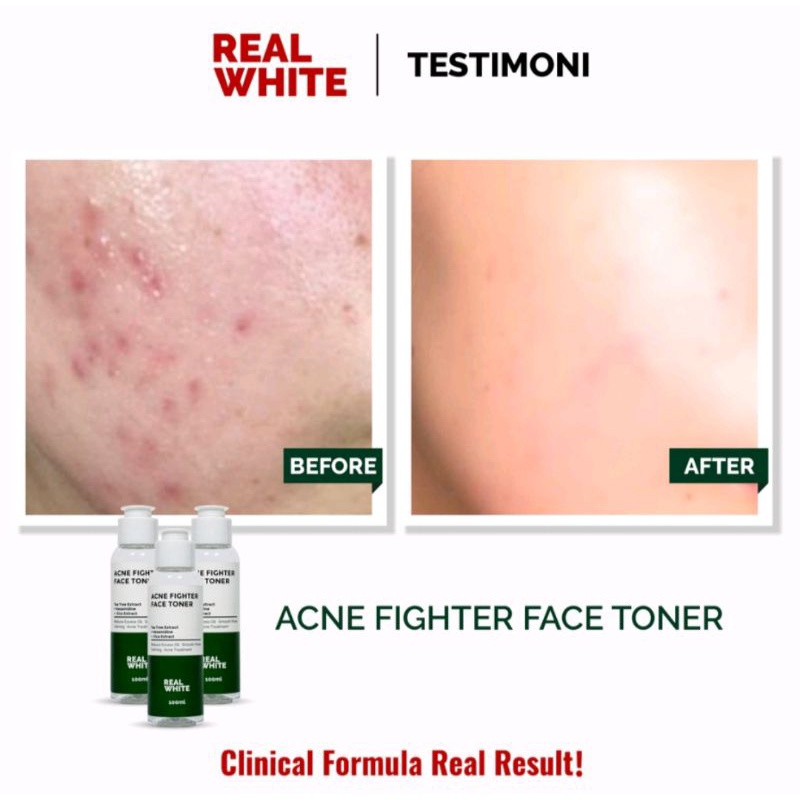 Real white acne fighter face toner/tea tree extract 100ml