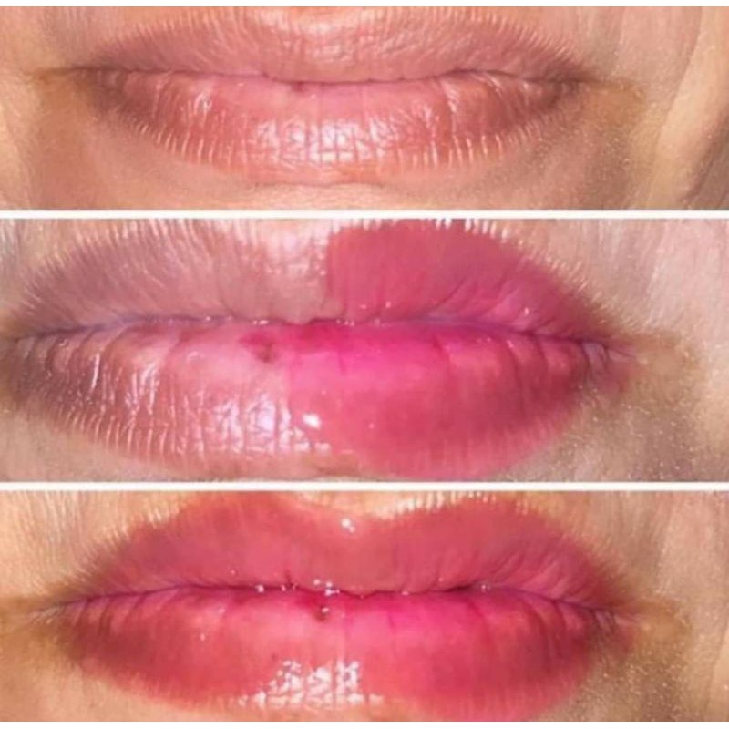 

RKLipserum