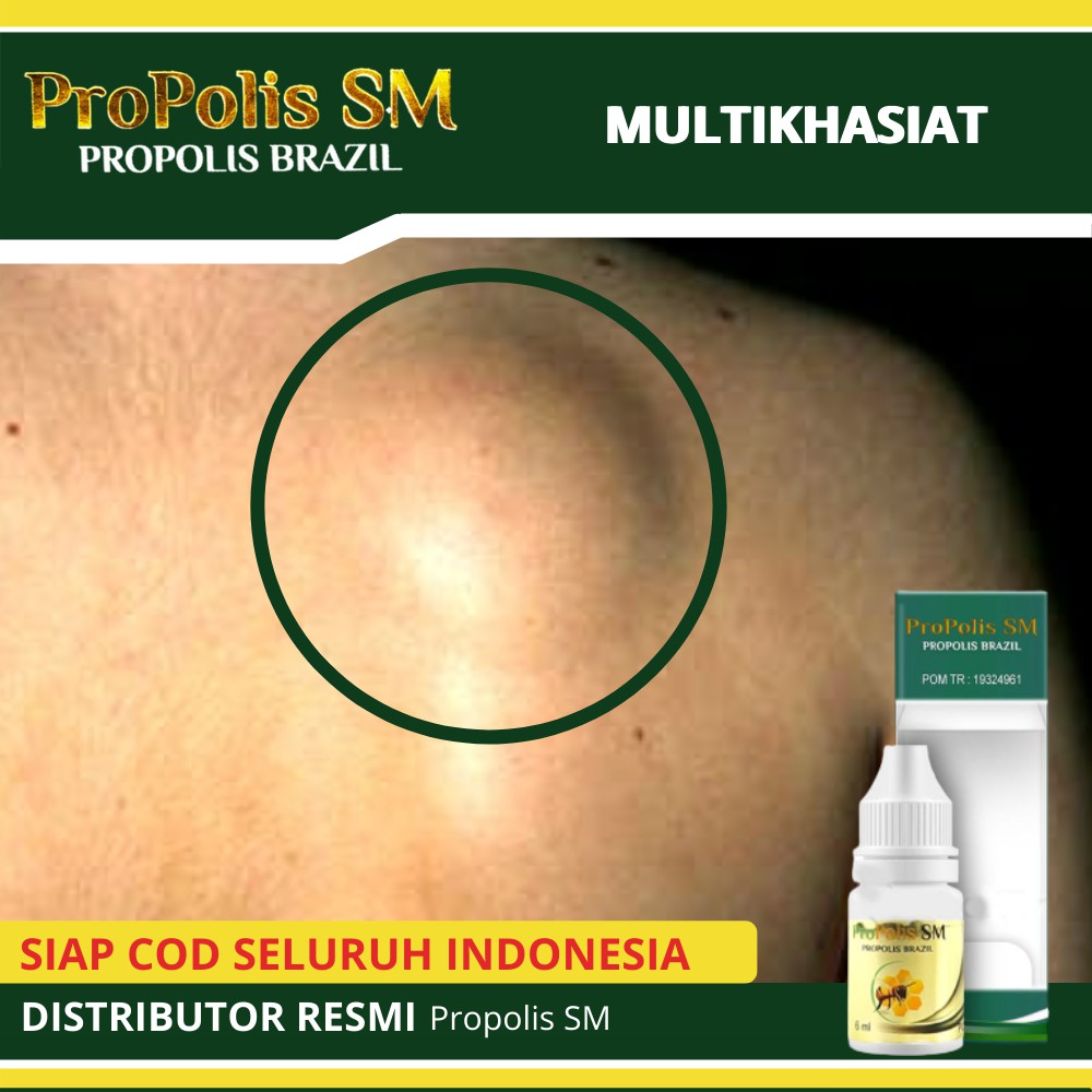 Obat Lipoma Di Punggung Obat Penghnacur Lipoma Benjolan Di Punggung Keras Propolis Sm Brazilian Shopee Indonesia