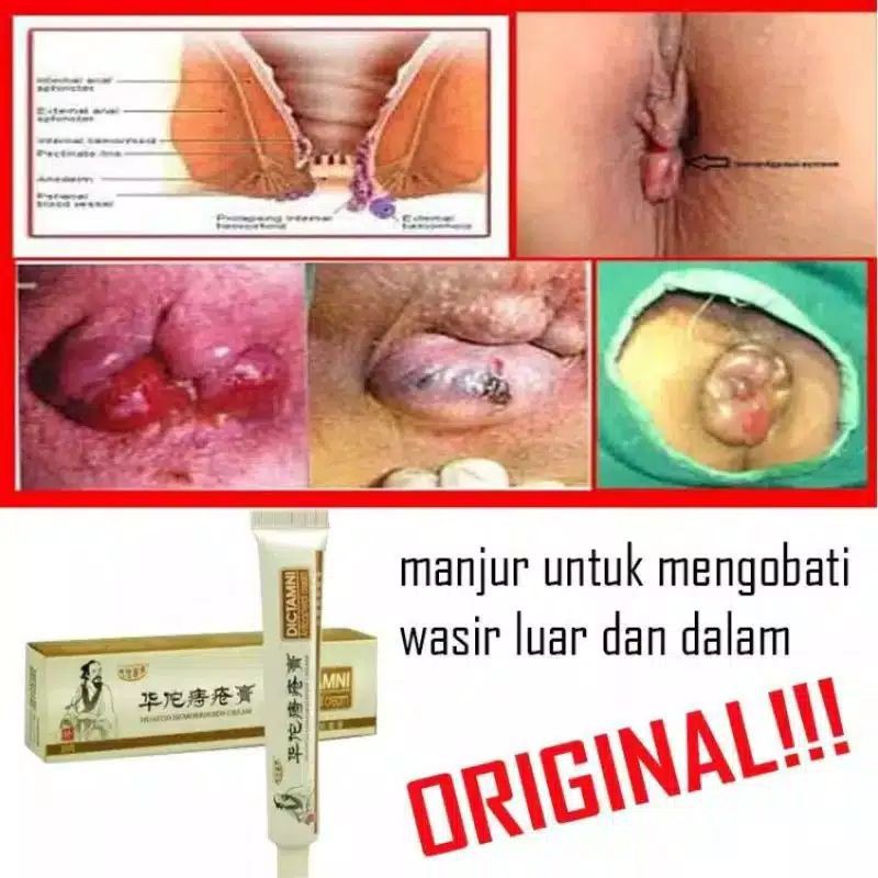 [ ORIGINAL ] Salep Obat Wasir Ambien Ampuh Ambeien Chinese Cina China Herbal Cream Anal anus Murah