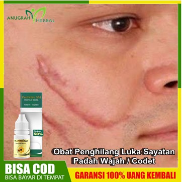 Obat Penghilang Luka Sayatan Pada Wajah / Codet - Koreng Bekas Luka Hitam| Propolis SM Original Herb
