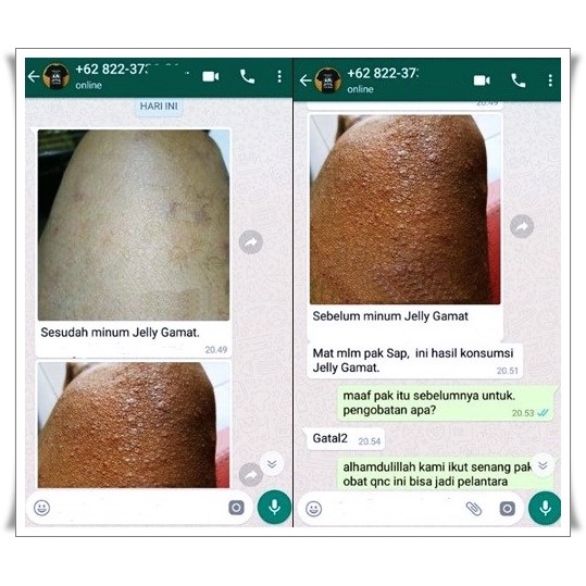 Atasi Keratosis Pilaris Dengan Perawatan Rumahan Ini