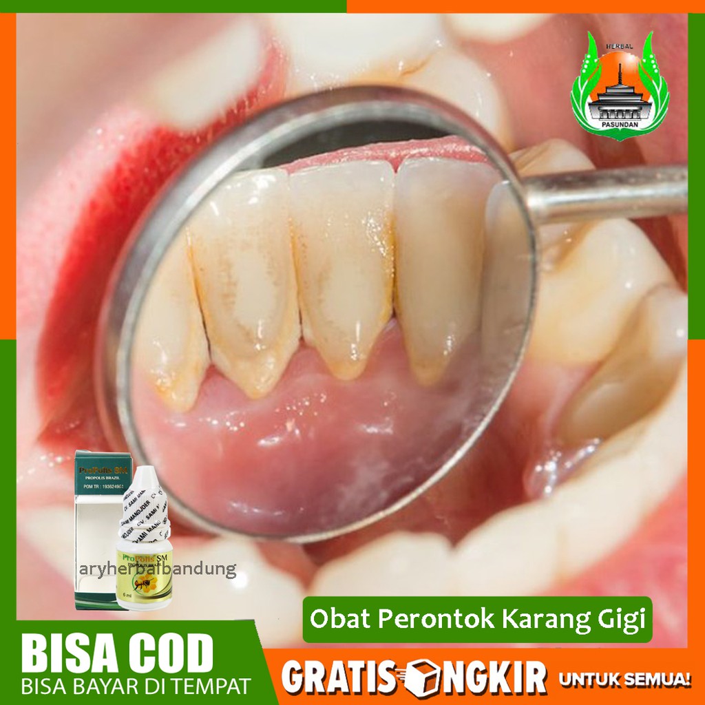 Obat Perontok Karang Gigi, Plak Gigi Herbal Propolis SM ASLI 100% - HALAL & Legal BPOM - Bisa COD