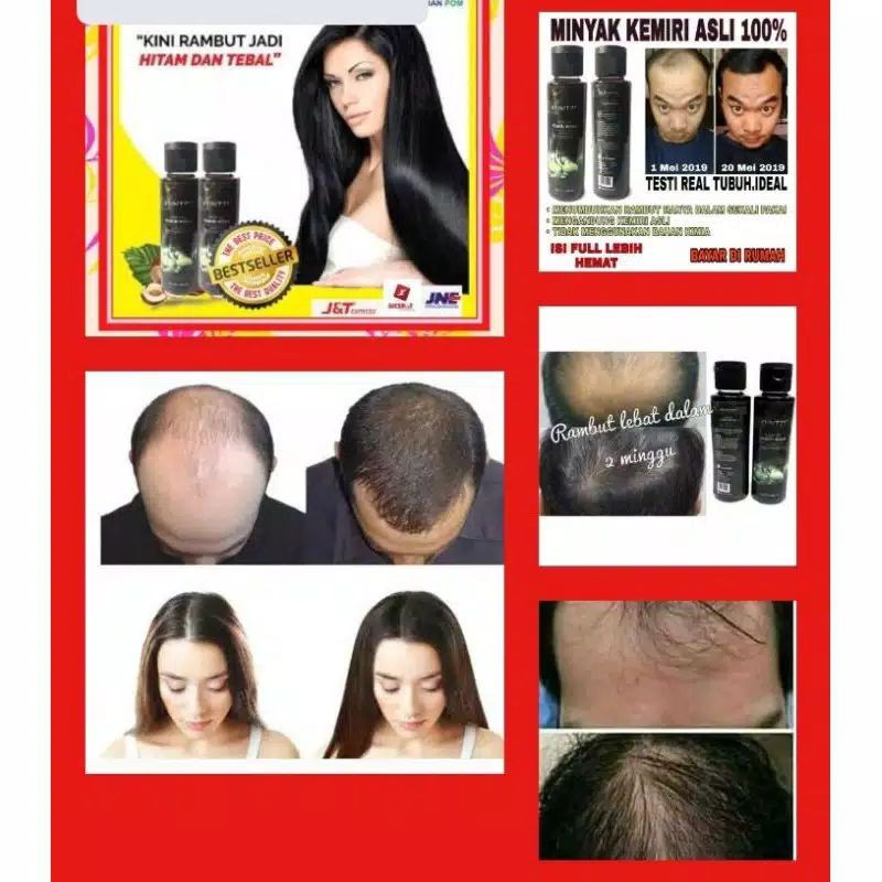 PENUMBUH RAMBUT CEPAT PENUMBUH RAMBUT PENUMBUH