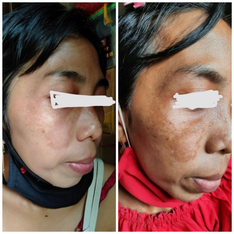 Paket Lengkap Flek (White Glow )