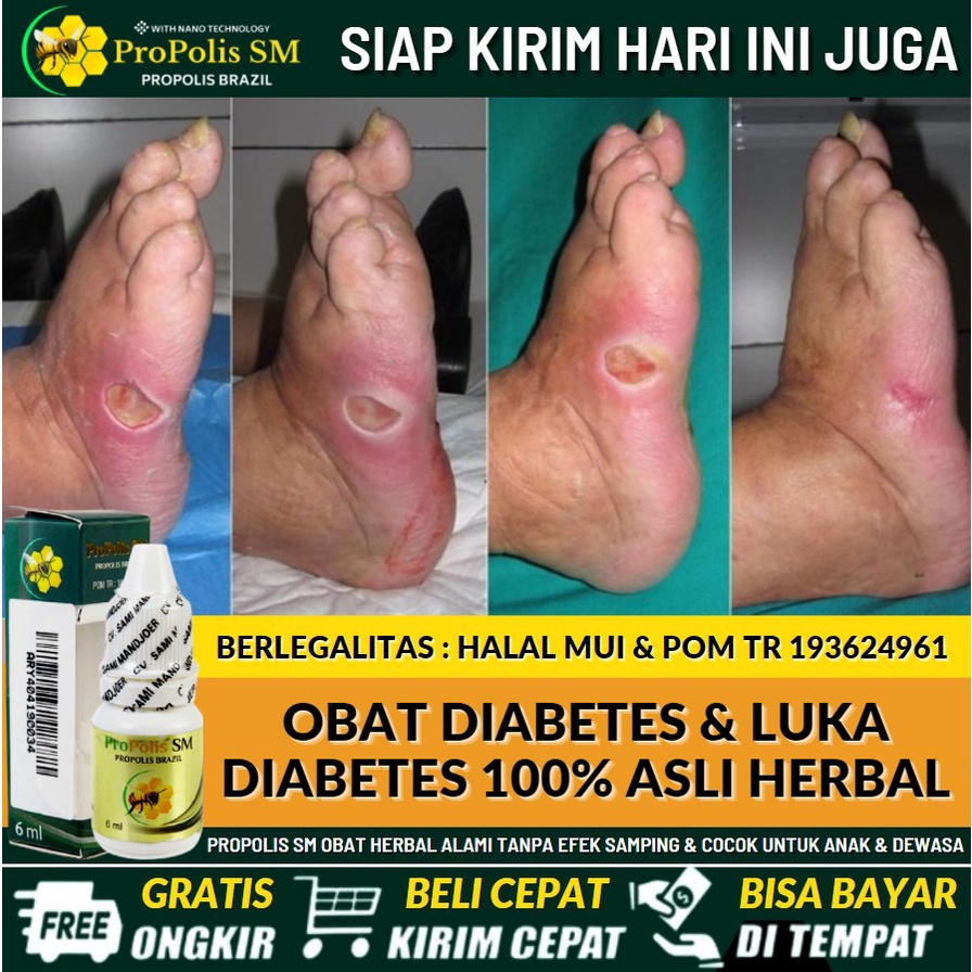 Salep Luka Diabetes Basah & Kering 100% Alami, Obat Oles Luka Diabetes Menahun, Luka Diabetes Terbuk