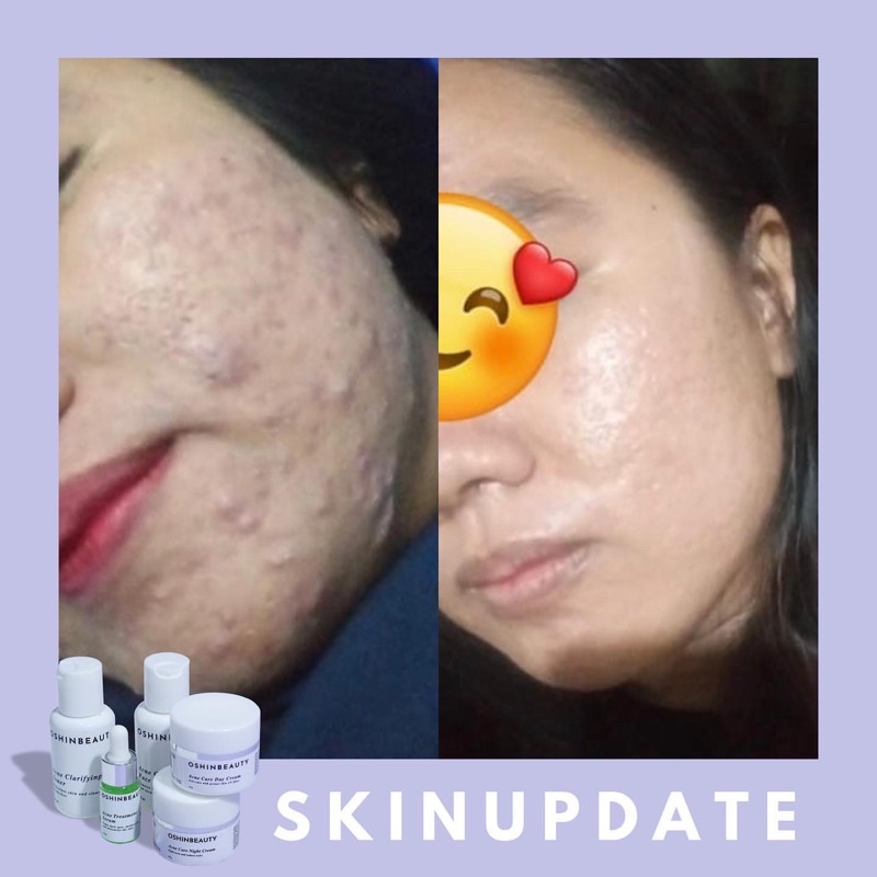 (OSHINBEAUTY) Paket Skincare Glow dan Acne Series Complete BPOM [Free Gift/Bonus]-4