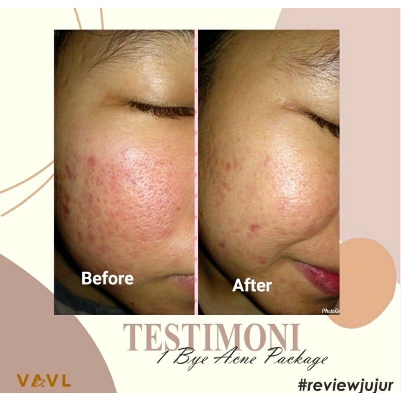 Vavl acne basic / blemish vavl / serum vavl / beauty water vavl