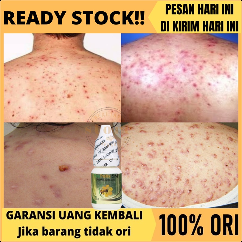 Obat Jerawat Punggung, enghilang jerawat Punggung, Salep Jerawat punggung dan bekasnya, Obat jerawat