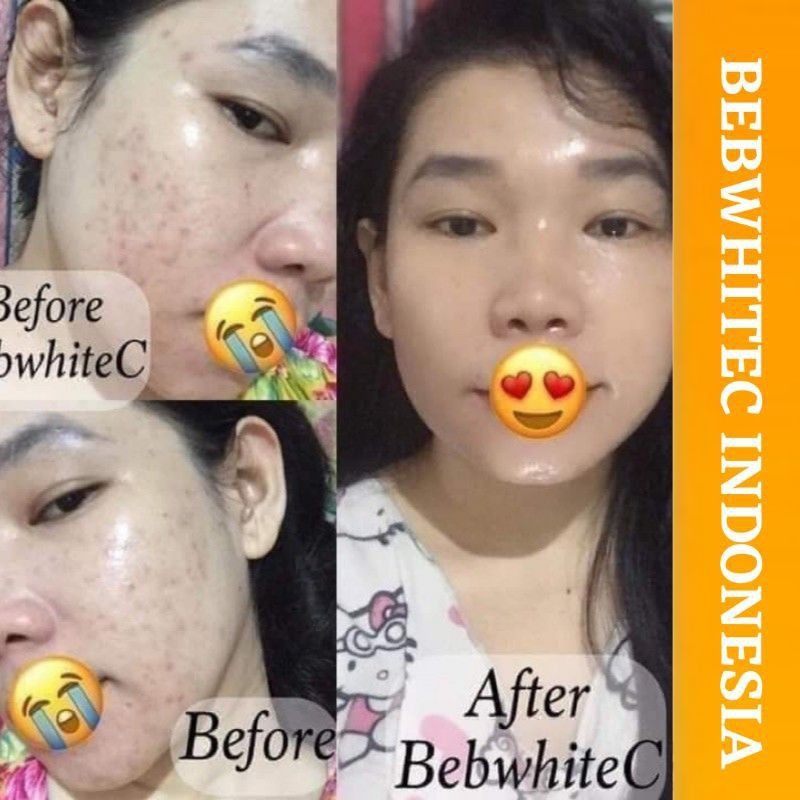 BEBWHITE C SKINCARE PAKET GLOW PAKET ACNE ORIGINAL BBC BPOM-6