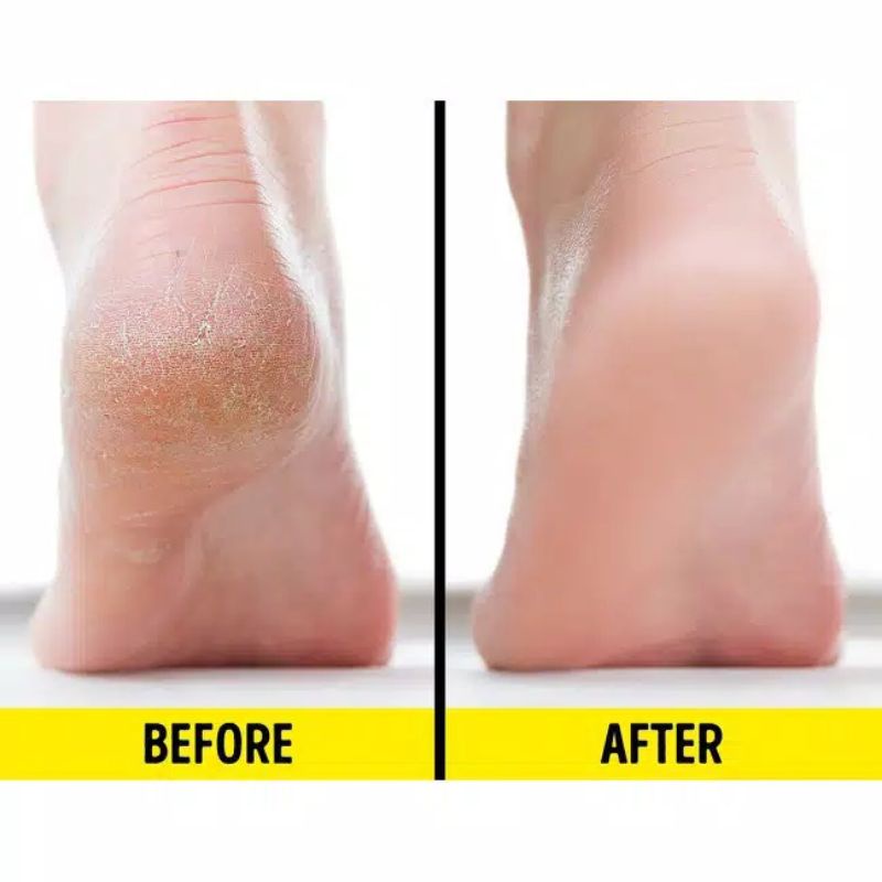 FOOT CREAM KAKI PECAH DAN KERING KASAR PECAH2 PENGHILANG KAPALAN TUMITKU