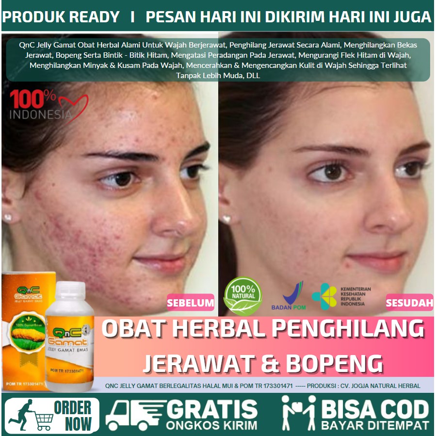 Obat Penghilang Bopeng Pria & Wanita, Meregenerasi Kulit Mati, QnC Jelly Gamat Obat Herbal Alami