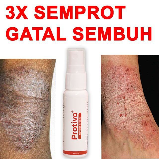OBAT EKSIM KERING MENAHUN OBAT GATAL KULIT BISA BUAT SELANGKANGAN PANU, JAMUR COD