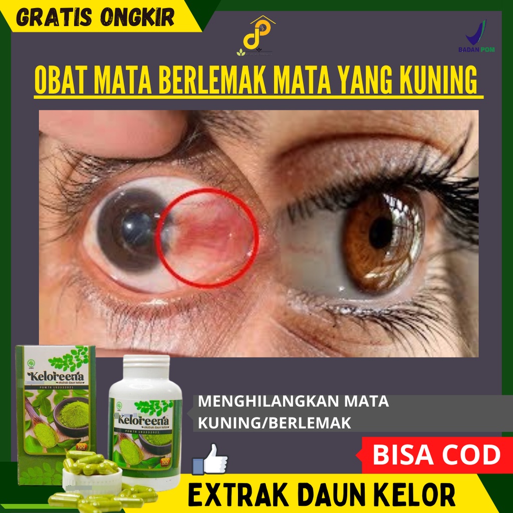 OBAT MATA BERLEMAK KAPSUL PEMBERSIH MATA YANG KUNING  PEMUTIH MATA KUNING PUCAT  KELORENA MENGHILANG